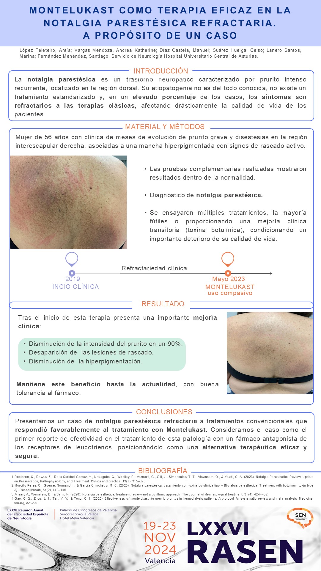 Montelukast como terapia eficaz en la notalgia parestésica refractaria. A propósito de un caso