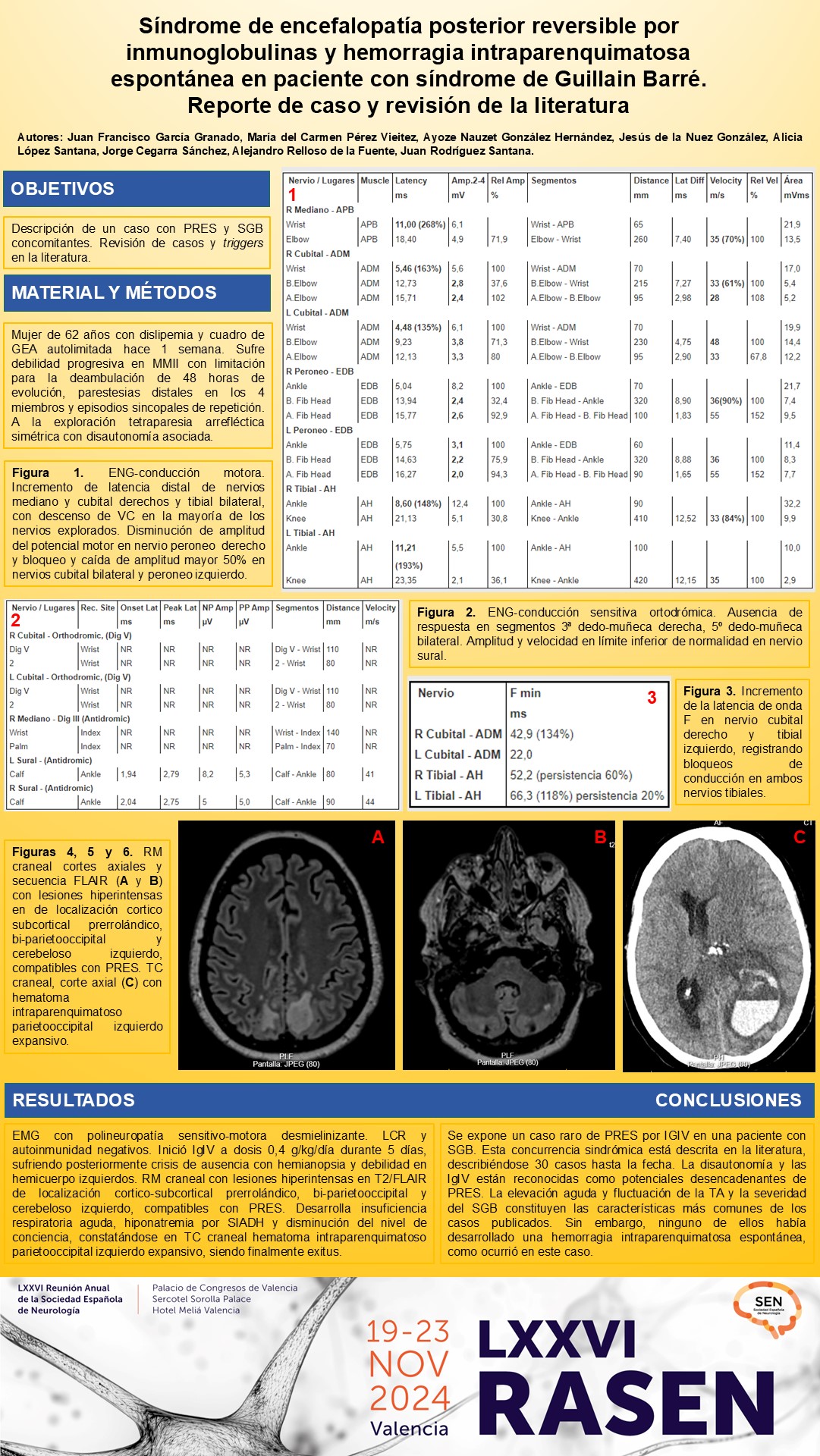 Síndrome de encefalopatía posterior reversible por inmunoglobulinas y hemorragia intraparenquimatosa espontánea en paciente con síndrome de Guillain Barré. Reporte de caso y revisión de la literatura