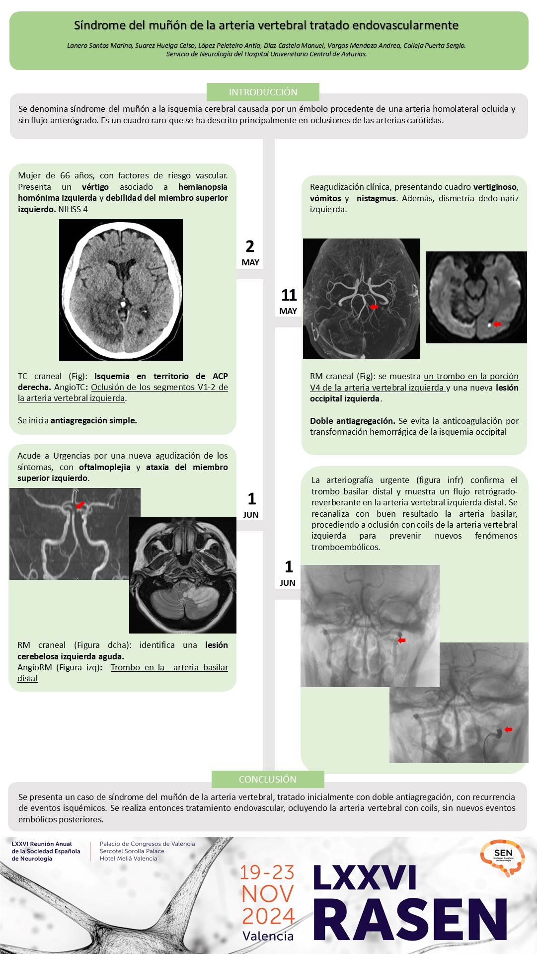 Síndrome del muñón de la arteria vertebral tratado endovascularmente