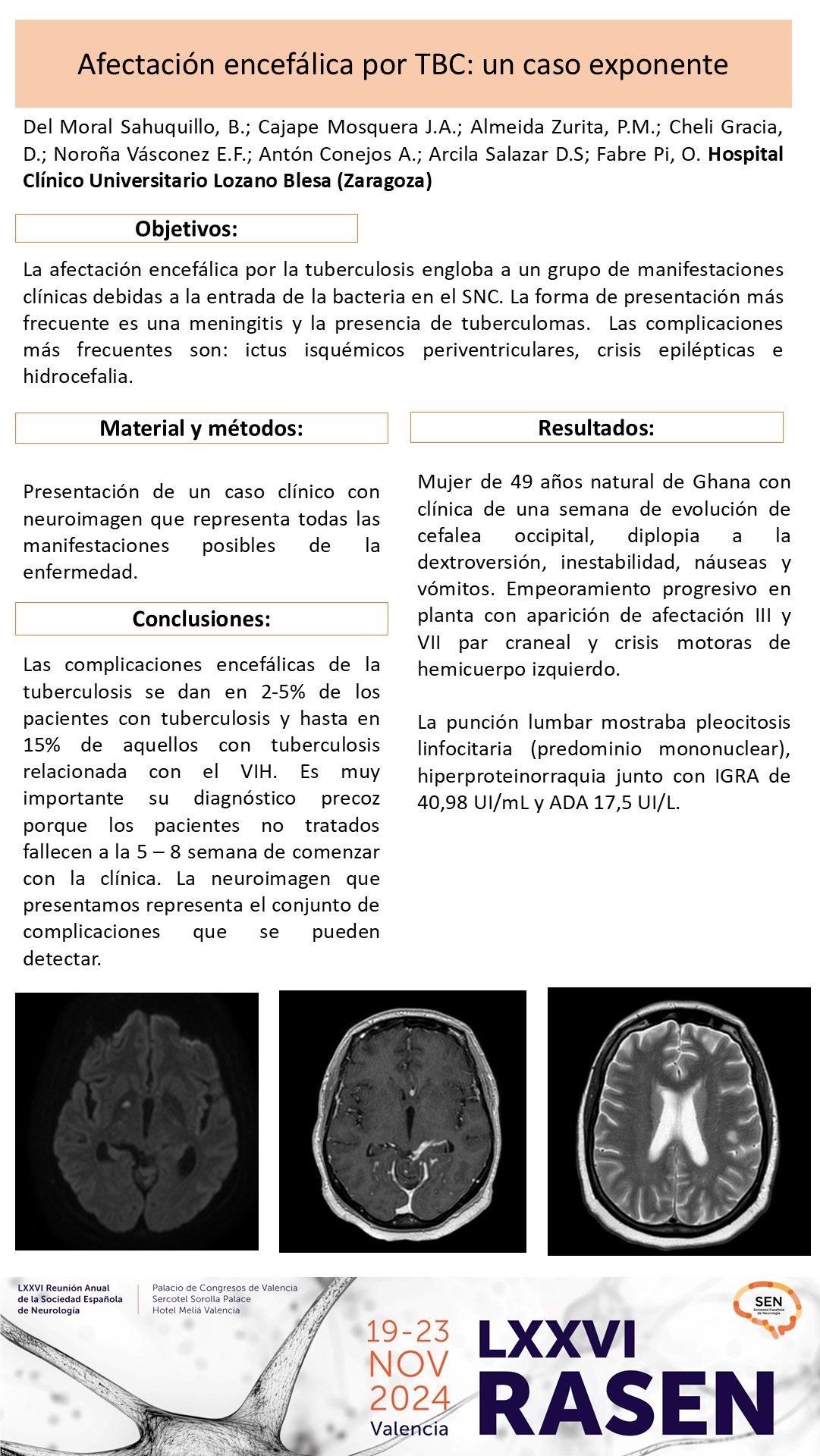 Afectación encefálica por TBC: un caso exponente