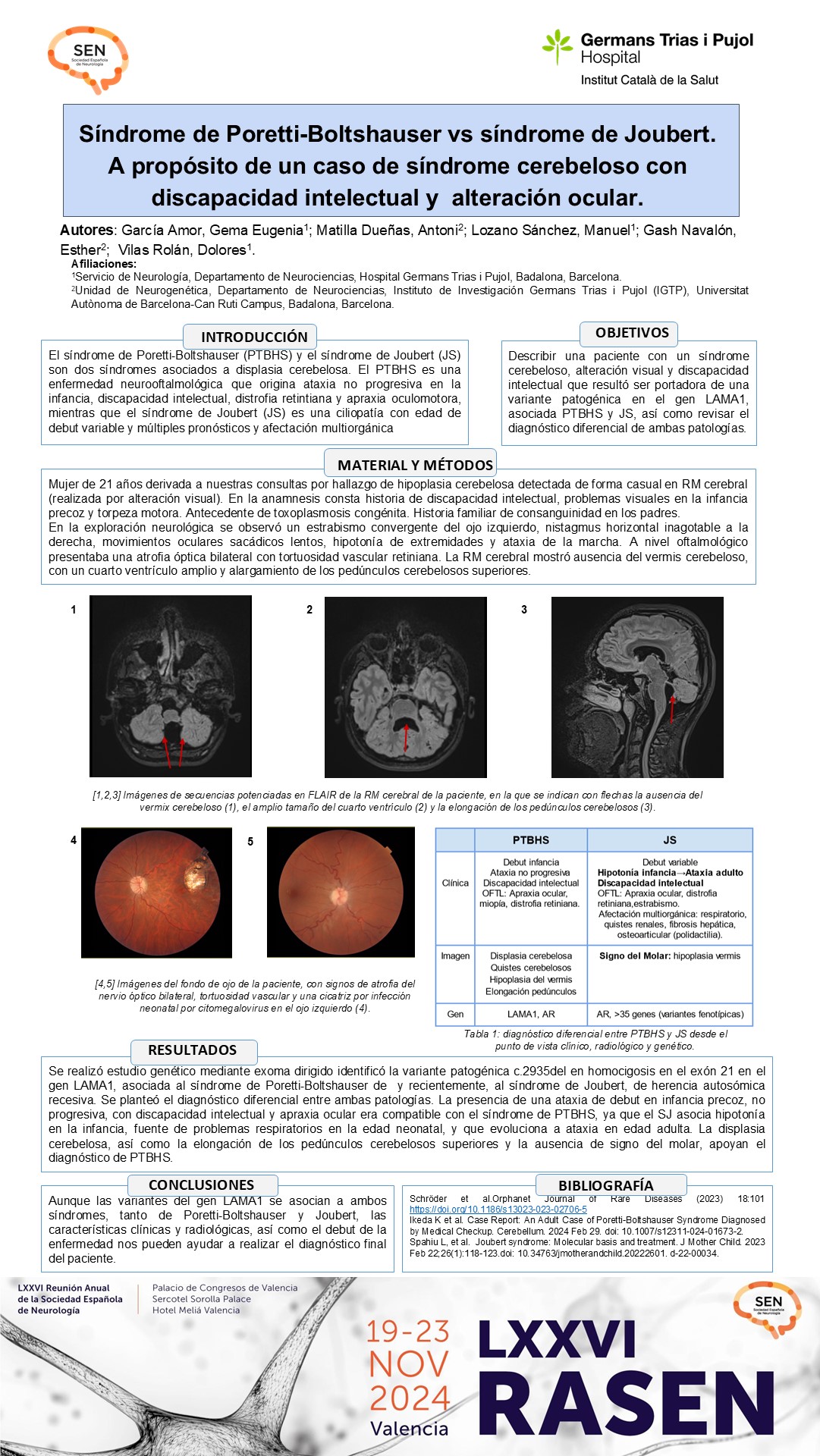 Síndrome de Poretti-Boltshauser vs síndrome de Joubert. A propósito de un caso de síndrome cerebeloso con discapacidad intelectual y alteración ocular