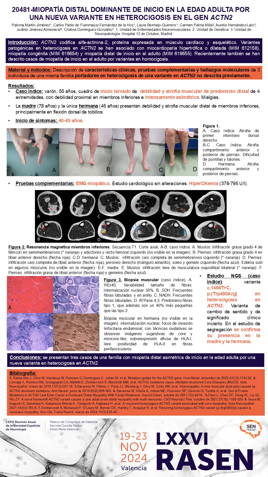 Miopatía distal dominante de inicio en la edad adulta por una nueva variante en heterocigosis en el gen ACTN2
