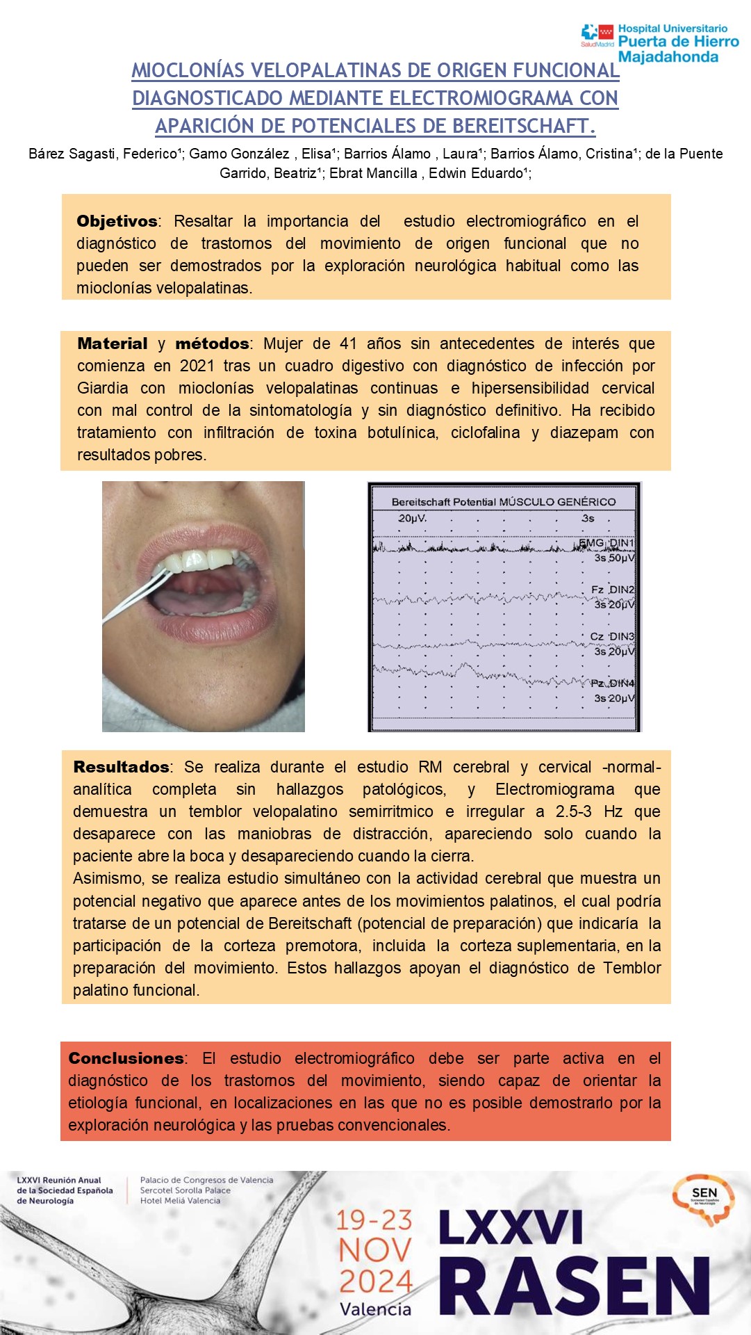 Mioclonías velopalatinas  de origen funcional  diagnosticado mediante electromiograma con aparición de potenciales de Bereitschaft