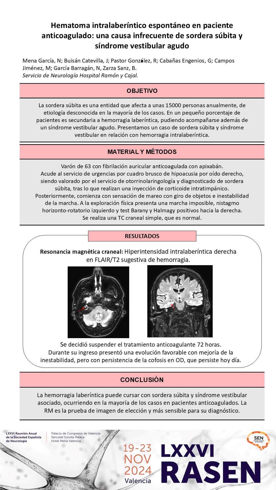 Hematoma intratimpánico espontáneo en paciente anticoagulado: una causa infrecuente de sordera súbita y síndrome vestibular agudo