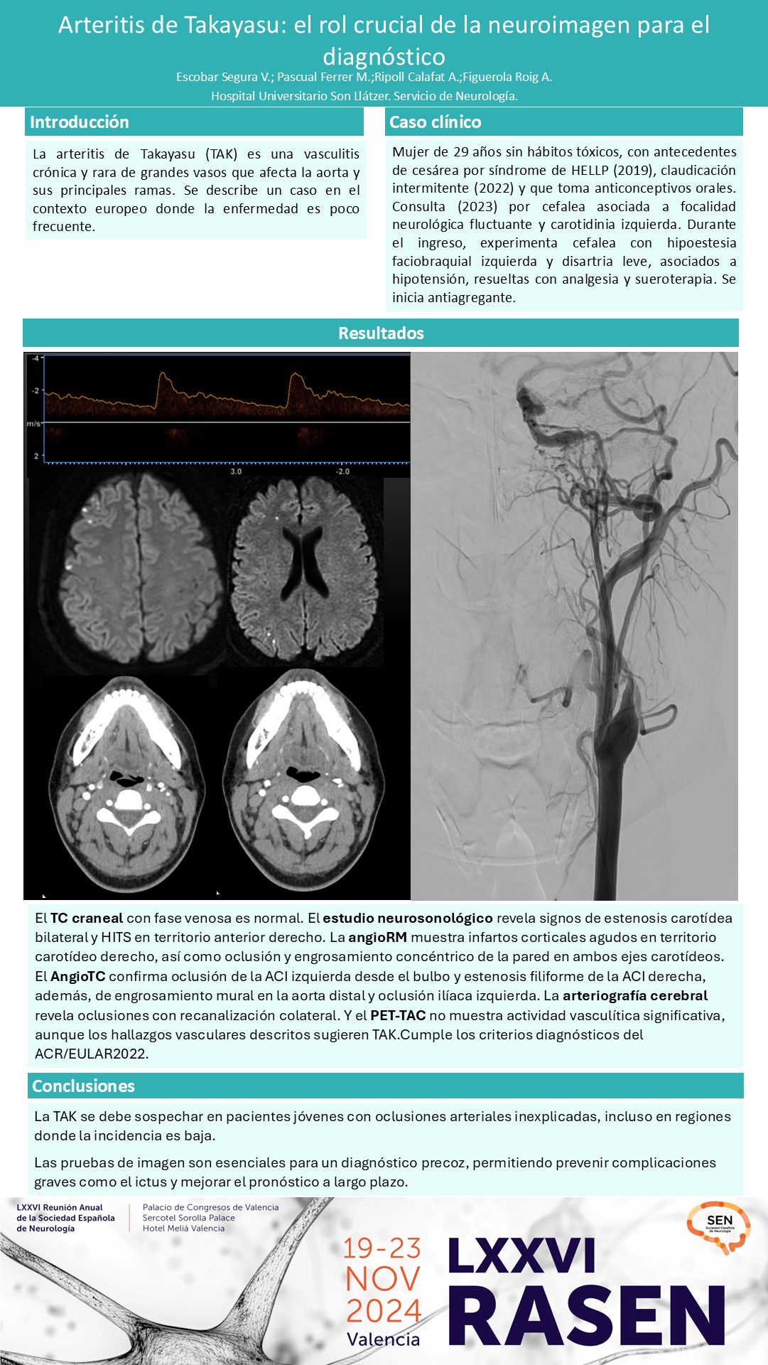 Arteritis de Takayasu: el rol crucial de la neuroimagen para el diagnóstico