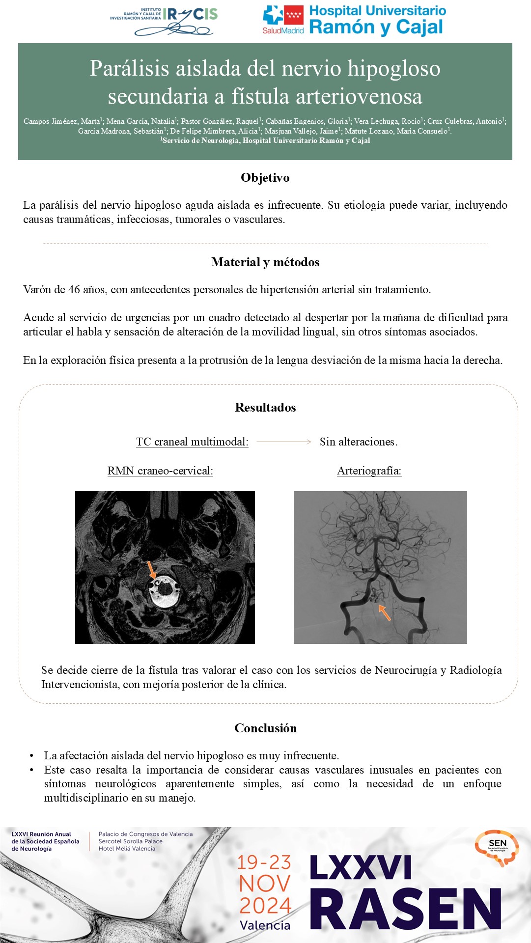 Parálisis aislada del nervio hipogloso secundaria a fístula arteriovenosa