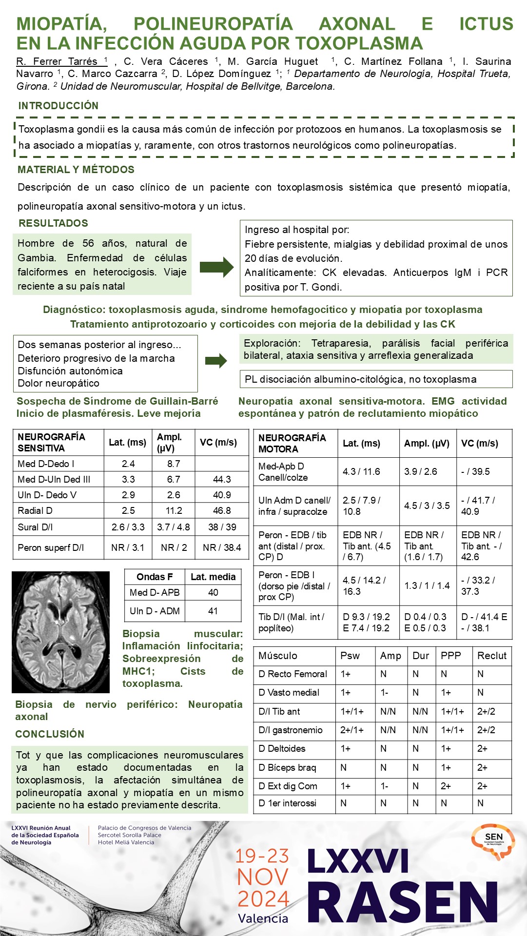 Miopatía, polineuropatía axonal e ictus en la infección aguda por Toxoplasma