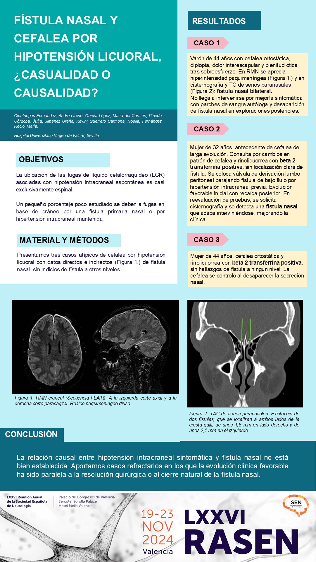 Fístula nasal y cefalea por hipotensión licuoral, ¿casualidad o causalidad?