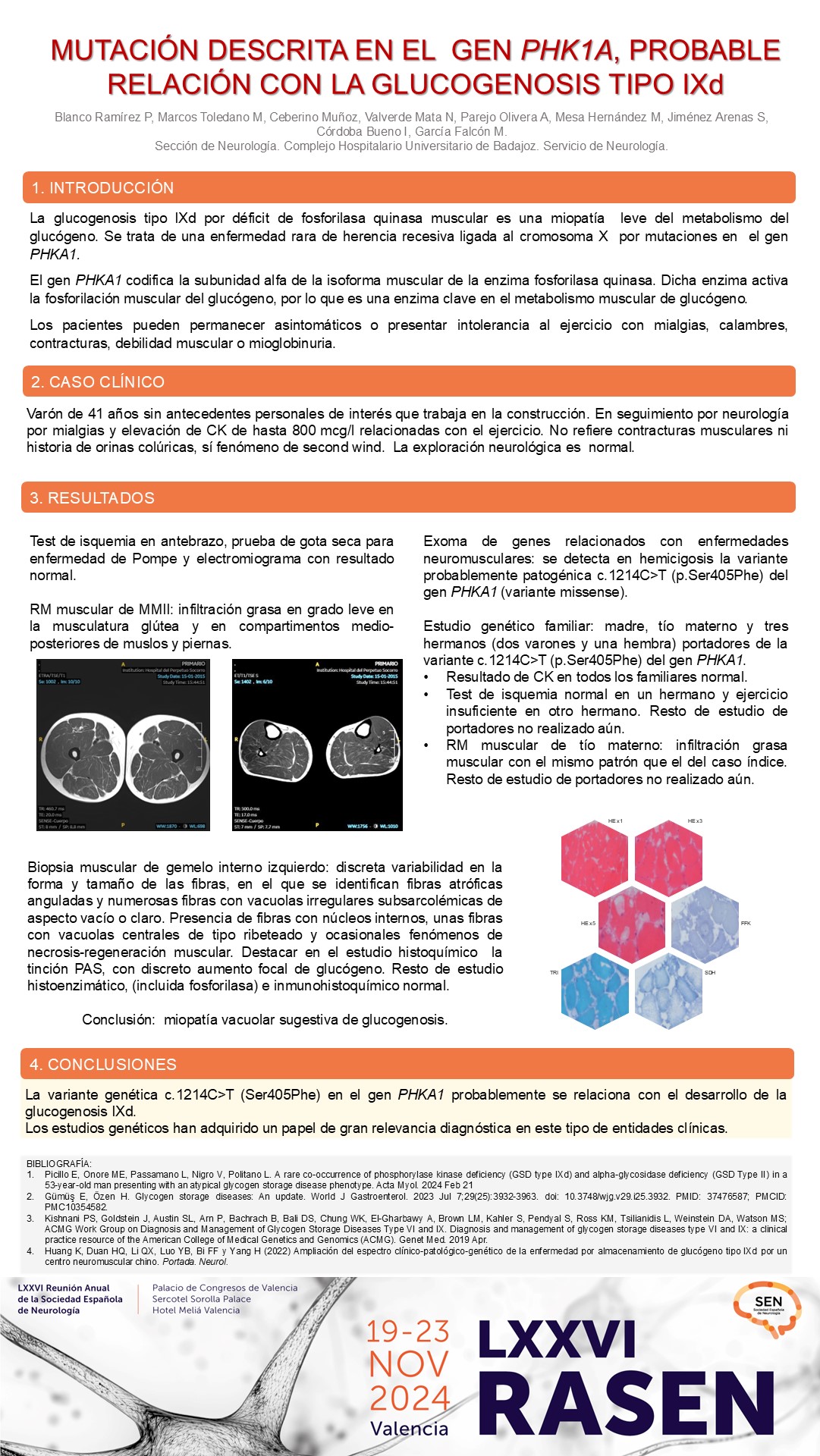 Mutación descrita en el gen PHKA1, probable relación con la Glucogenosis tipo IXd