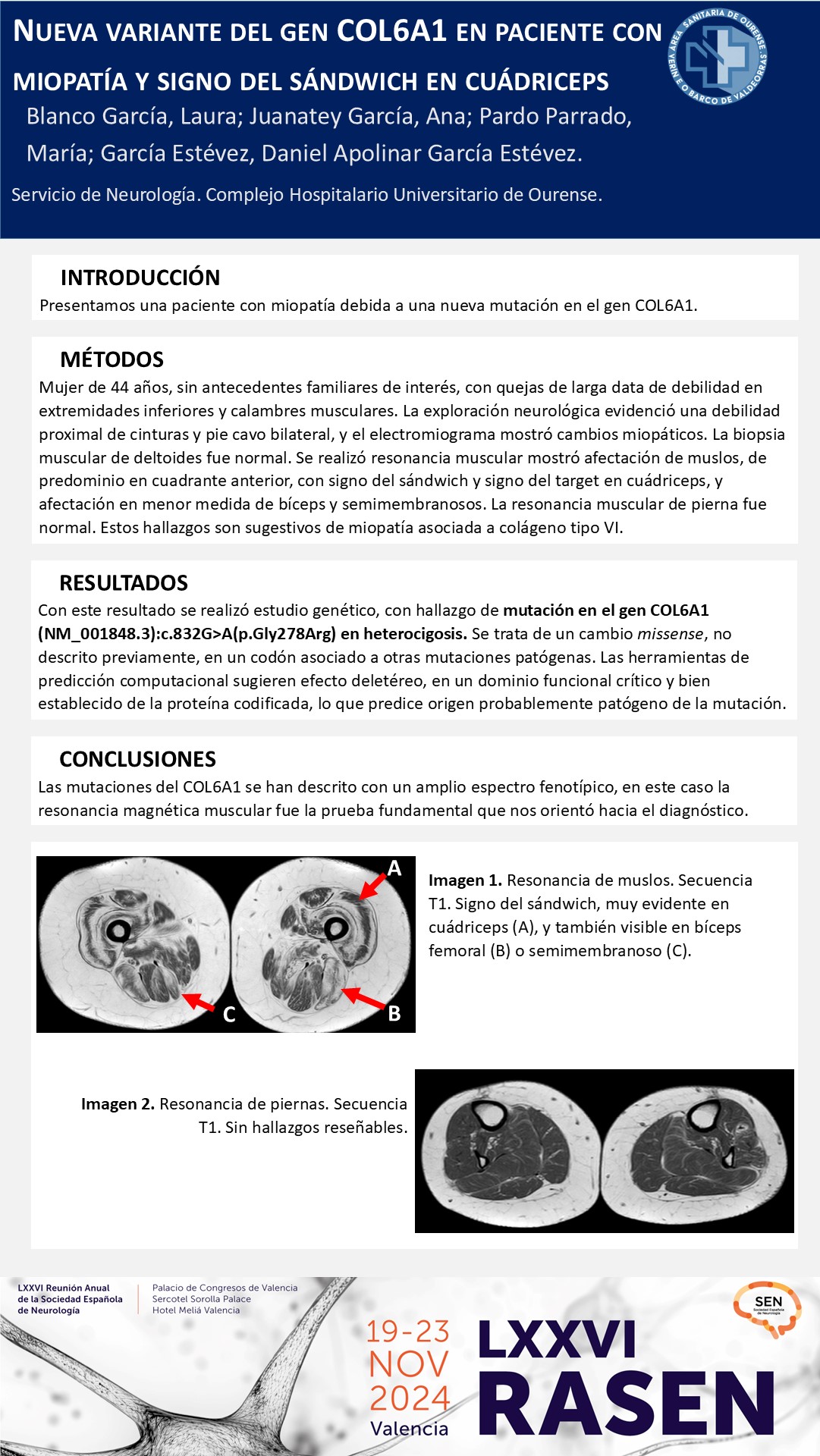 Nueva variante del gen COL6A1 en paciente con miopatía y signo del sándwich en cuádriceps