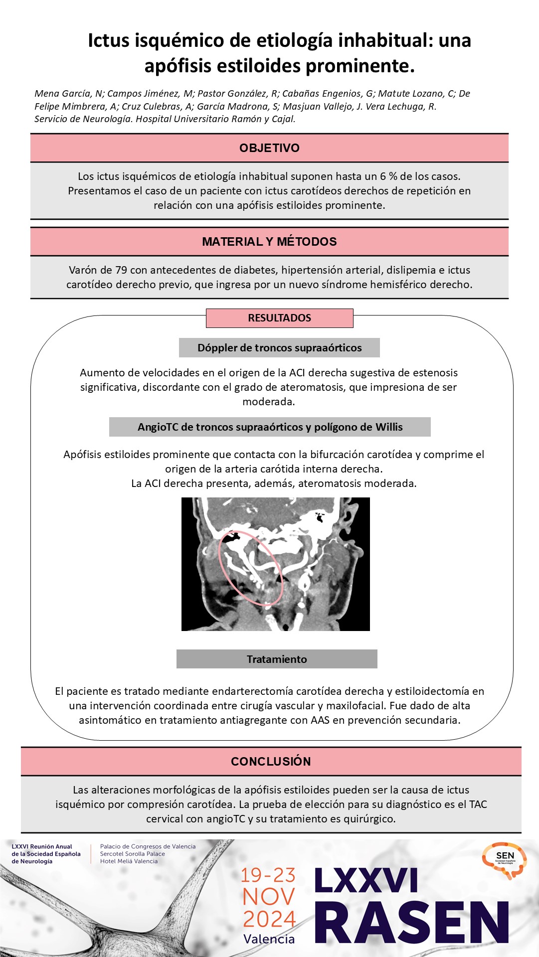 Ictus isquémico de etiología inhabitual: una apófisis estiloides prominente