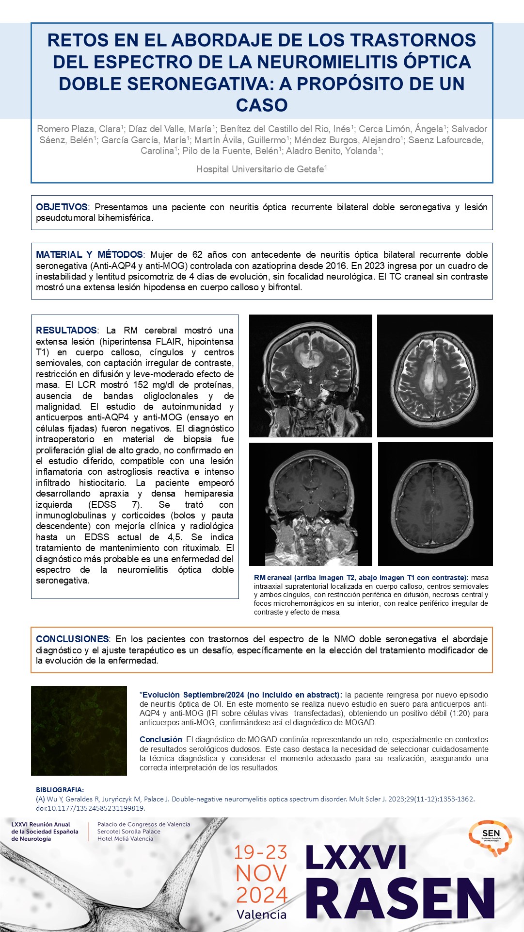 Retos en el abordaje de los trastornos del espectro de la neuromielitis óptica doble seronegativa: a propósito de un caso