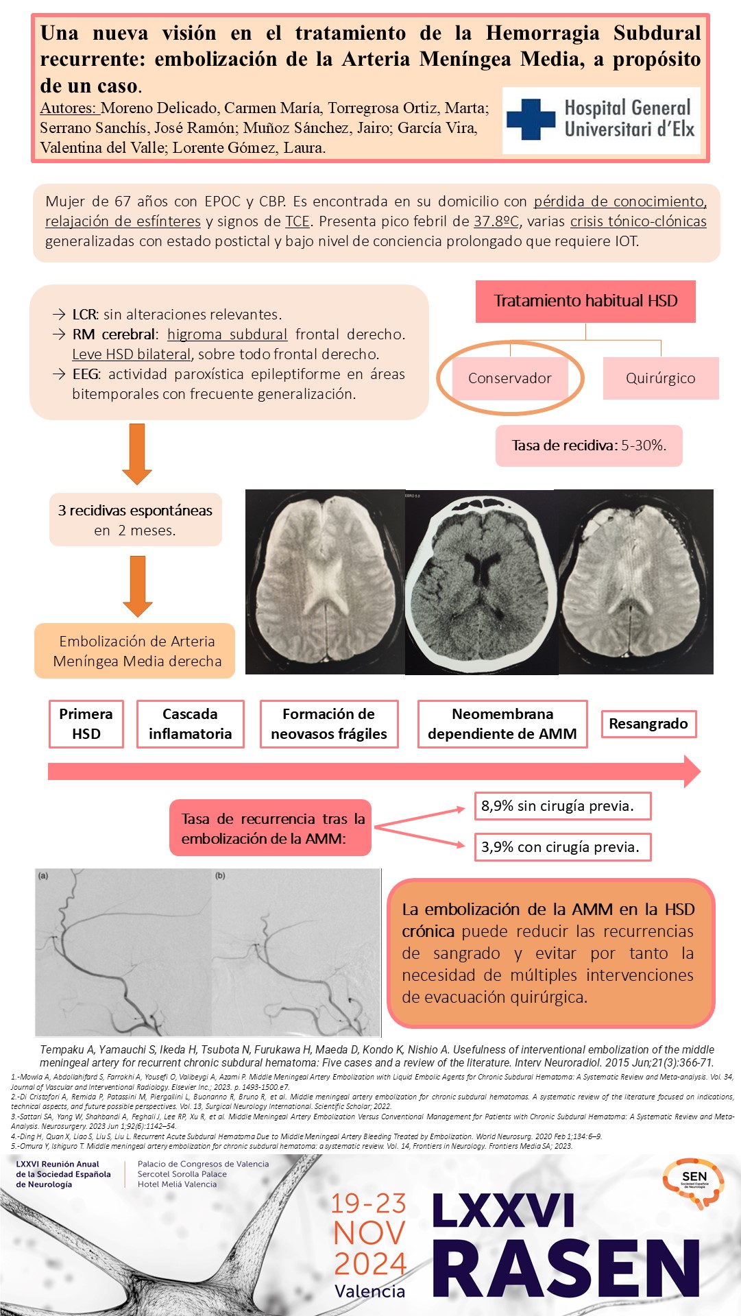 Una nueva visión en el tratamiento de la HSD: embolización de la Arteria Meníngea Media a propósito de un caso
