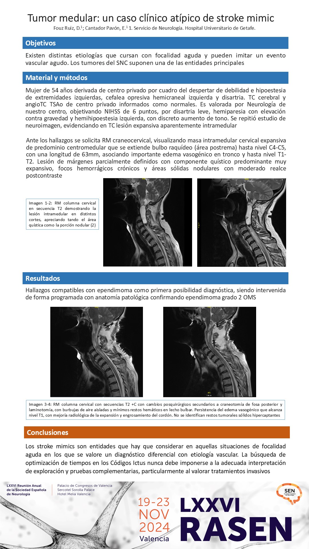 Tumor medular: un caso clínico atípico de stroke mimic
