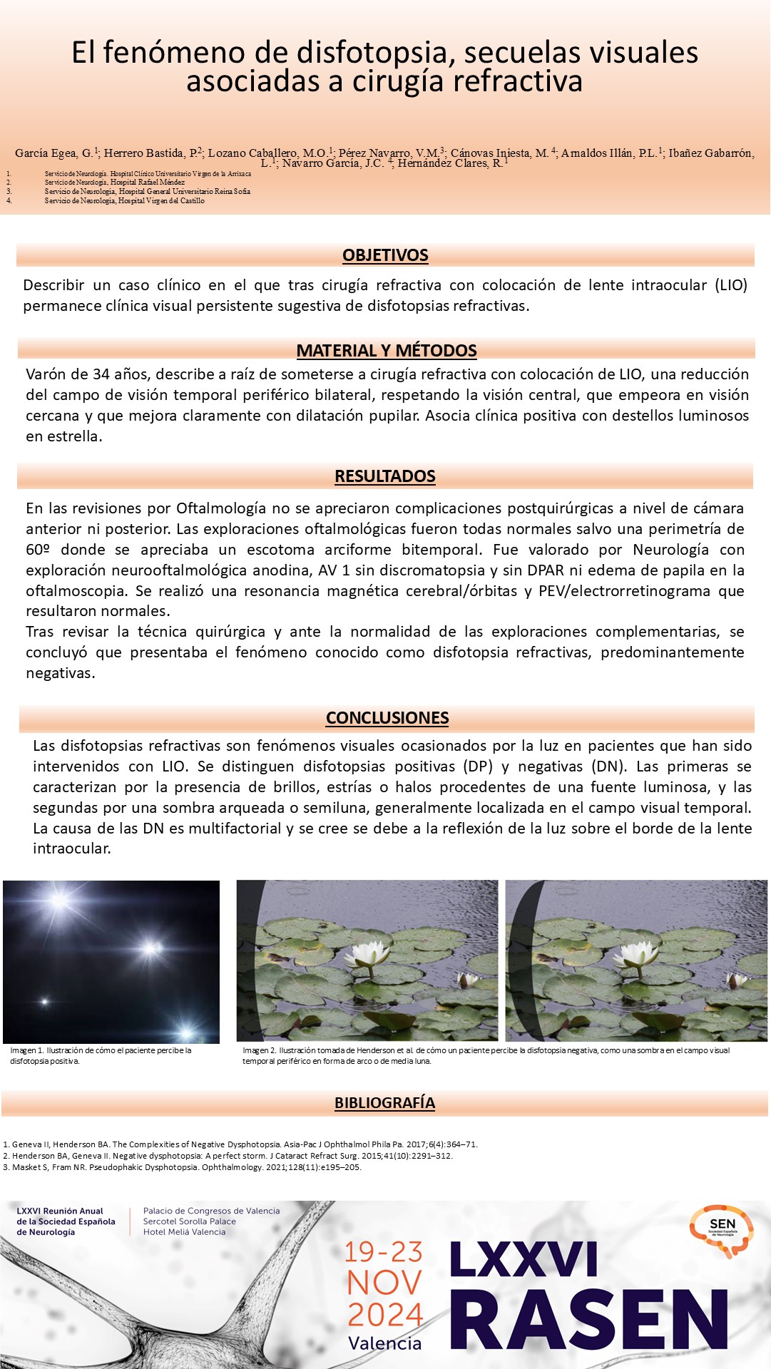 El fenómeno de disfotopsia, secuelas visuales asociadas a cirugía refractiva