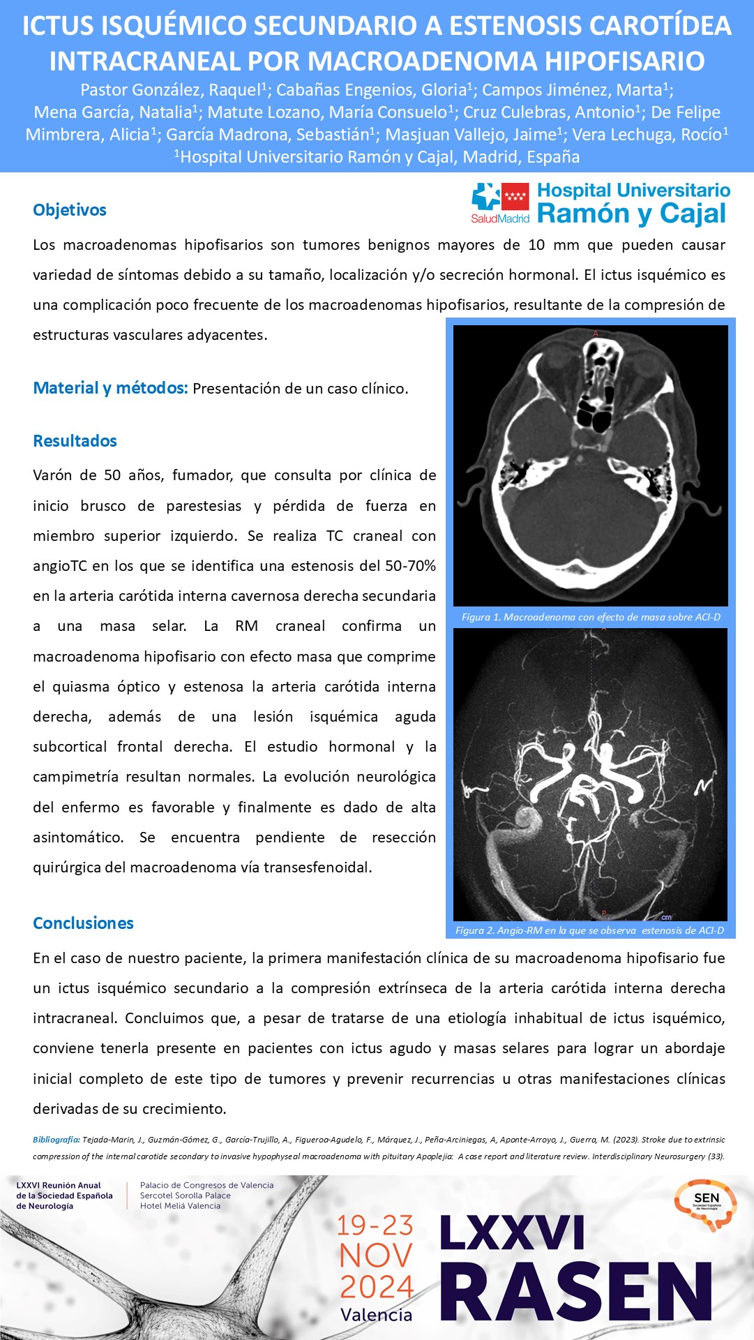 Ictus isquémico secundario a estenosis carotídea intracraneal por macroadenoma hipofisario