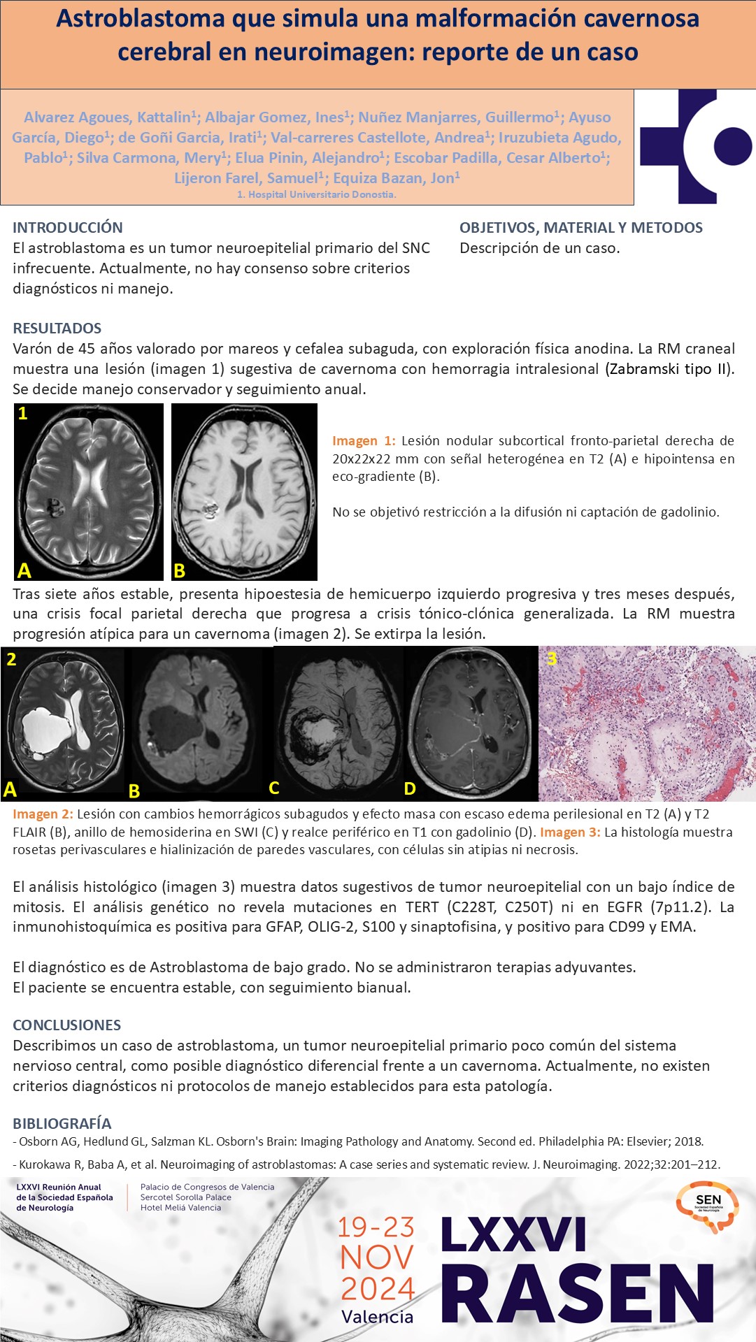 Astroblastoma que simula una malformación cavernosa cerebral en neuroimagen: reporte de un caso