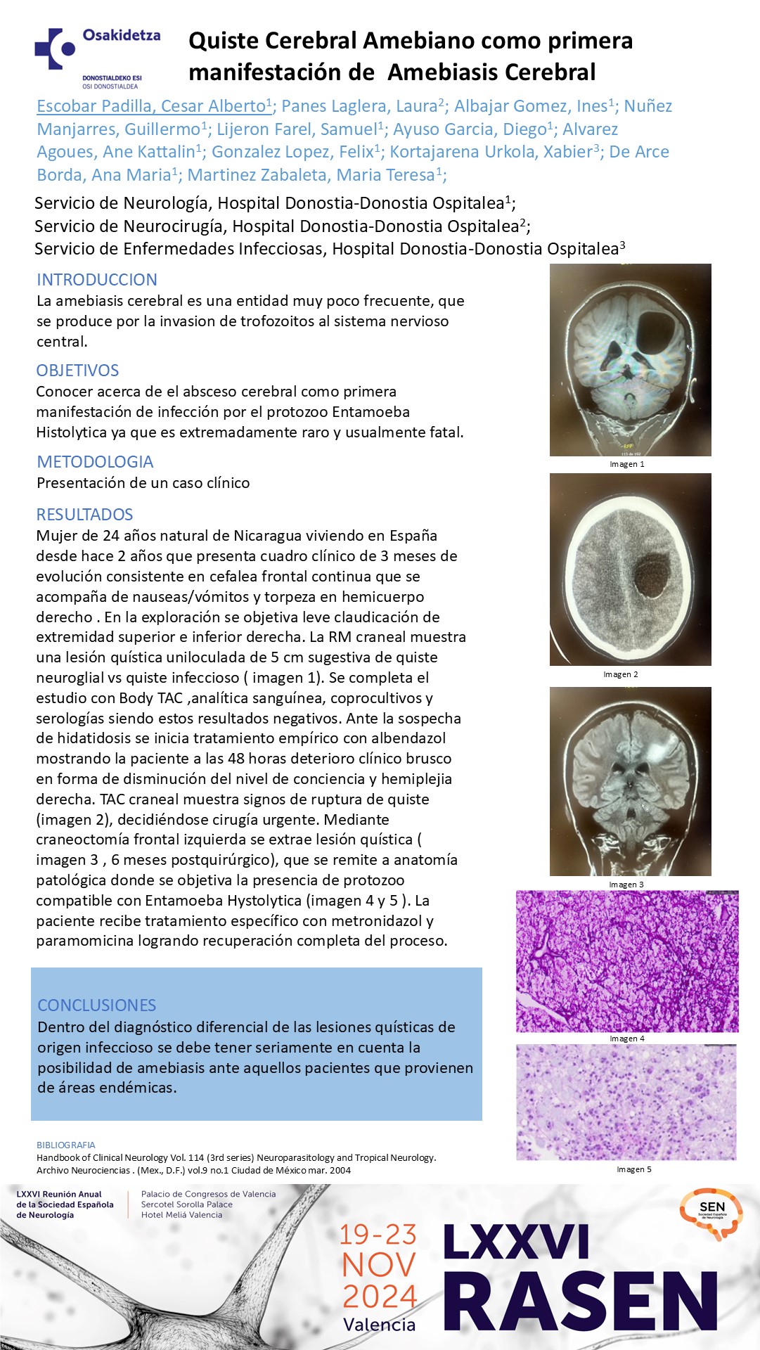 Quiste cerebral como primera manifestación de Amebiasis cerebral 