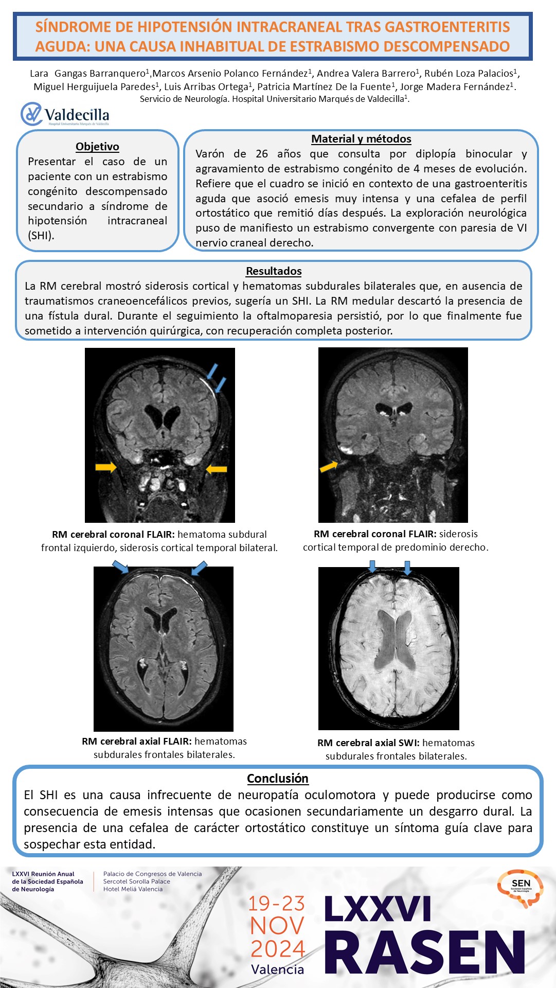 Síndrome de hipotensión intracraneal tras gastroenteritis aguda: una causa inhabitual de estrabismo descompensado