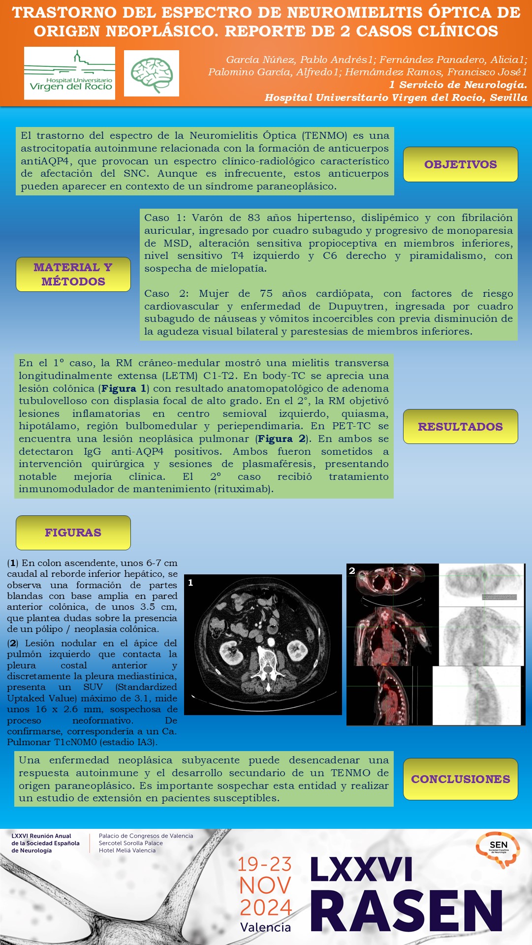 Trastorno del espectro de neuromielitis óptica de origen neoplásico. Reporte de dos casos clínicos
