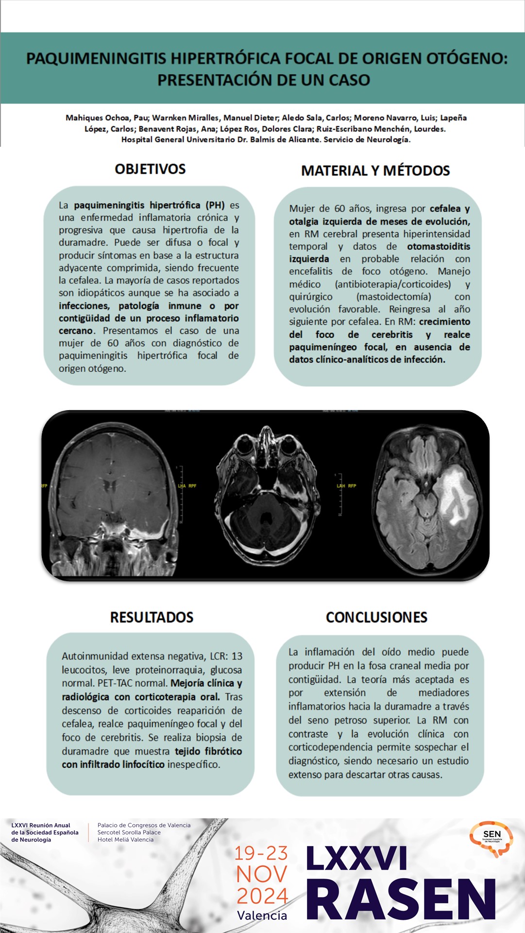 Paquimeningitis hipertrófica focal de origen otógeno: presentación de un caso