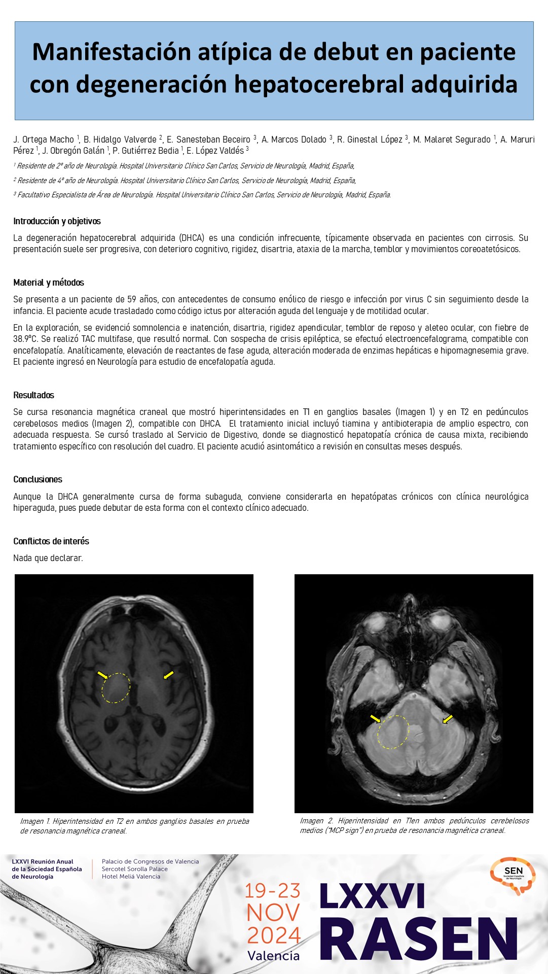 Debut agudo de una patología crónica: degeneración hepatocerebral adquirida