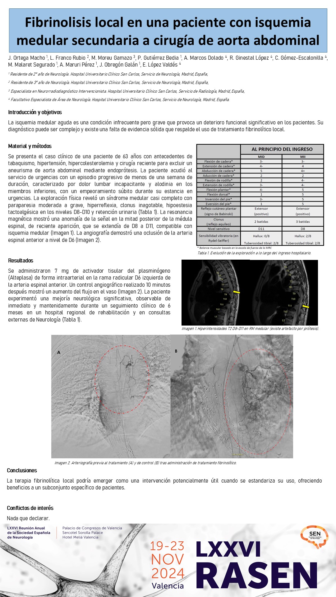 Fibrinolisis local en una paciente con isquemia medular secundaria a cirugía de aorta abdominal