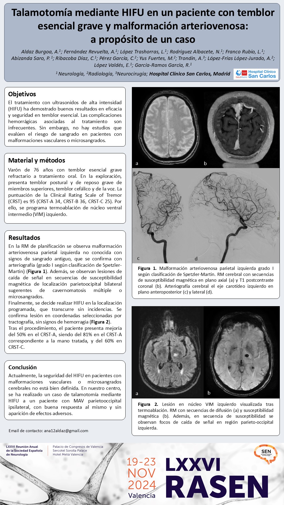 Talamotomía mediante HIFU en un paciente con temblor esencial grave y malformación arteriovenosa: a propósito de un caso