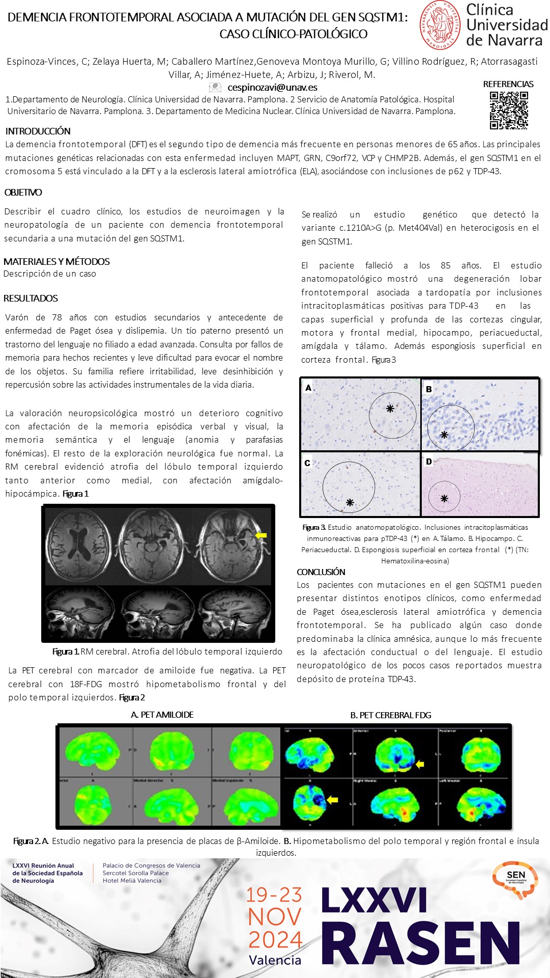 Demencia frontotemporal asociada a mutación del gen SQSTM1: caso clínico-patológico