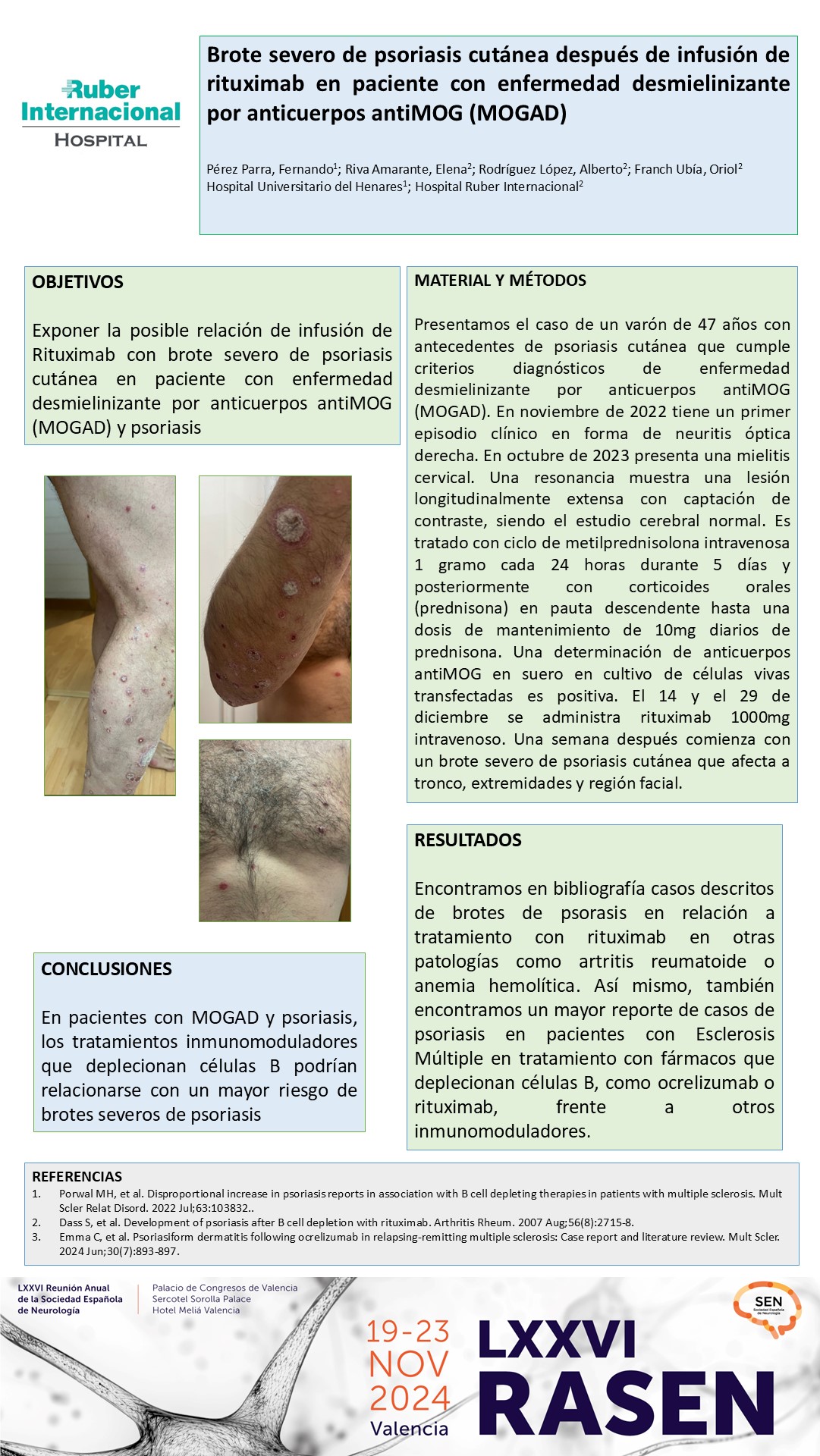 Brote severo de psoriasis cutánea después de infusión de rituximab en paciente con enfermedad desmielinizante por anticuerpos antiMOG (MOGAD)