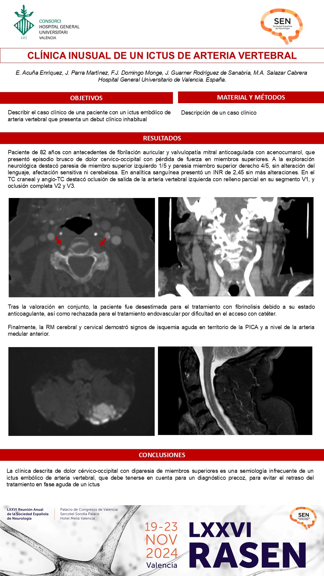 Clínica inusual de un ictus de arteria vertebral