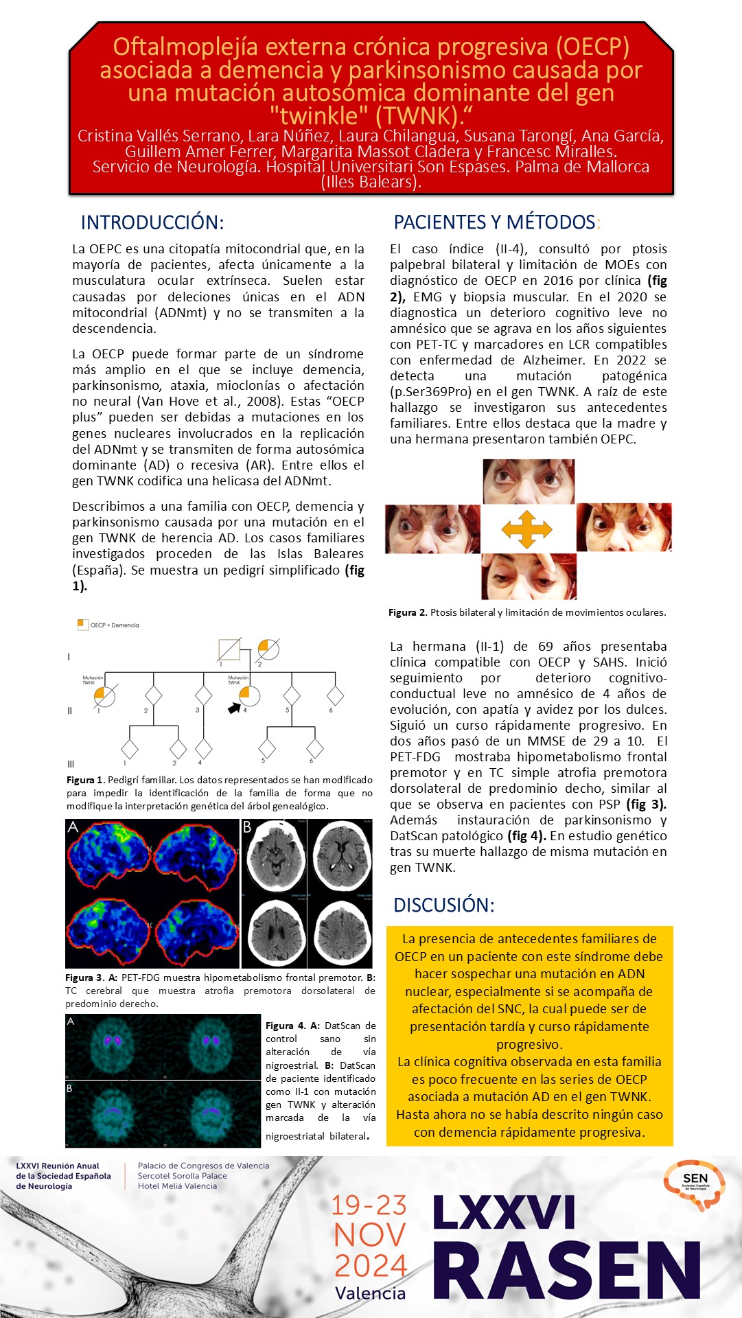 Oftalmoplejía externa crónica progresiva asociada a demencia y parkinsonismo causada por una mutación autosómica dominante del gen TWNK