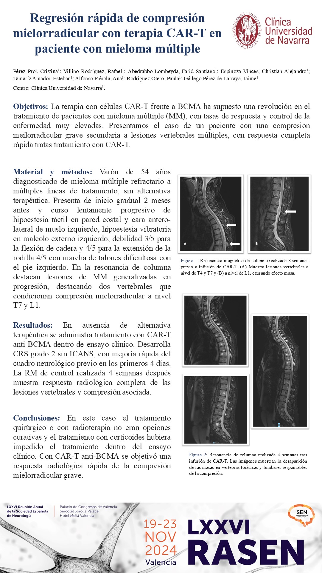 Regresión rápida de compresión mielorradicular con terapia CAR-T en paciente con mieloma múltiple