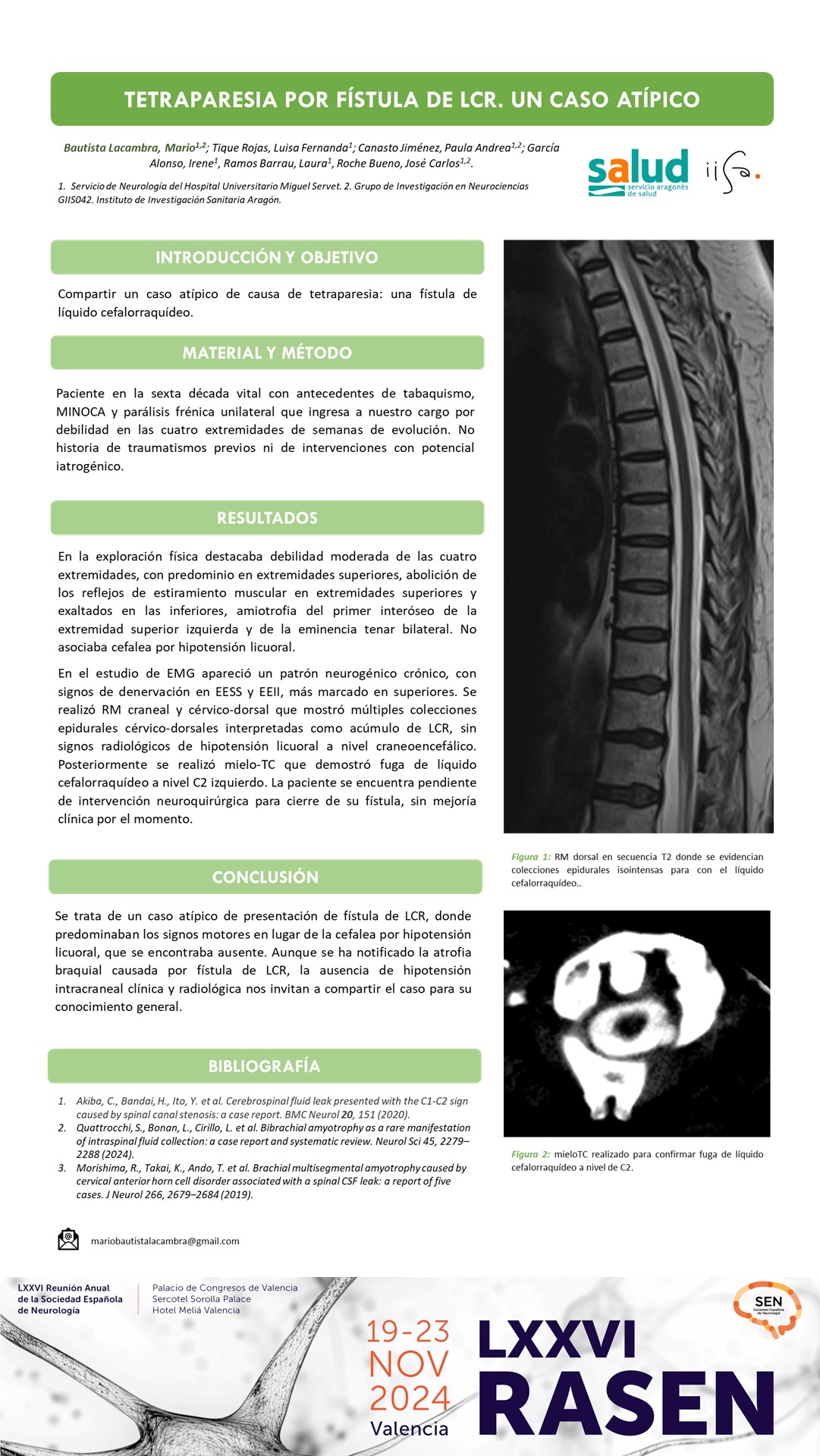 Tetraparesia por fístula de LCR: un caso atípico
