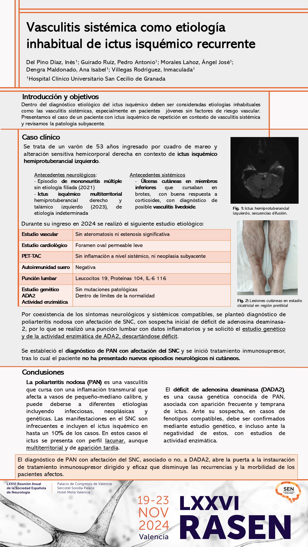 Vasculitis sistémica como etiología inhabitual de ictus isquémico recurrente