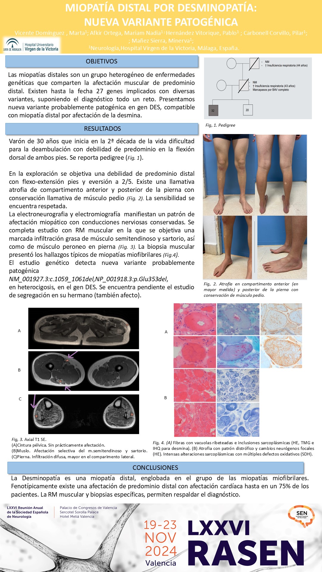 Miopatía distal por desminopatía: Nueva variante patogénica