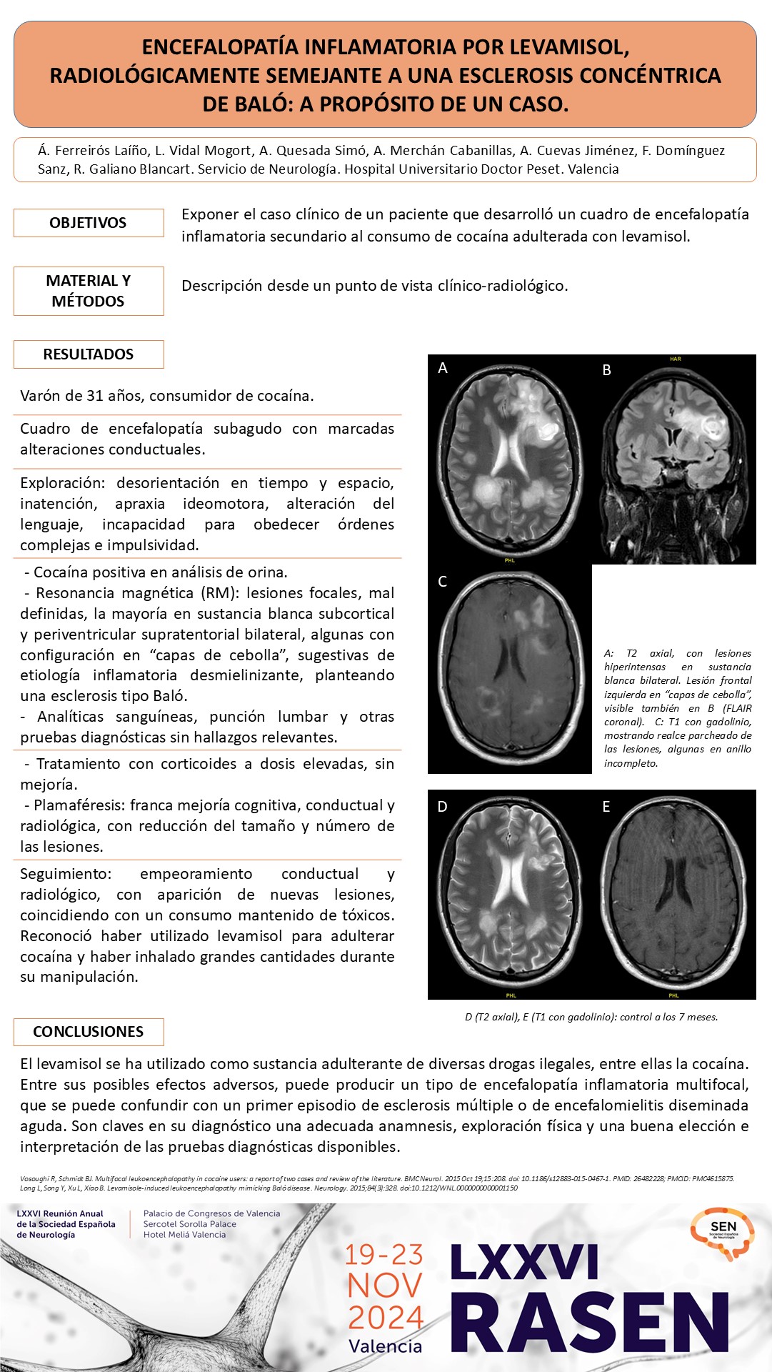 Encefalopatía inflamatoria por levamisol, radiológicamente semejante a una Esclerosis concéntrica de Baló: a propósito de un caso