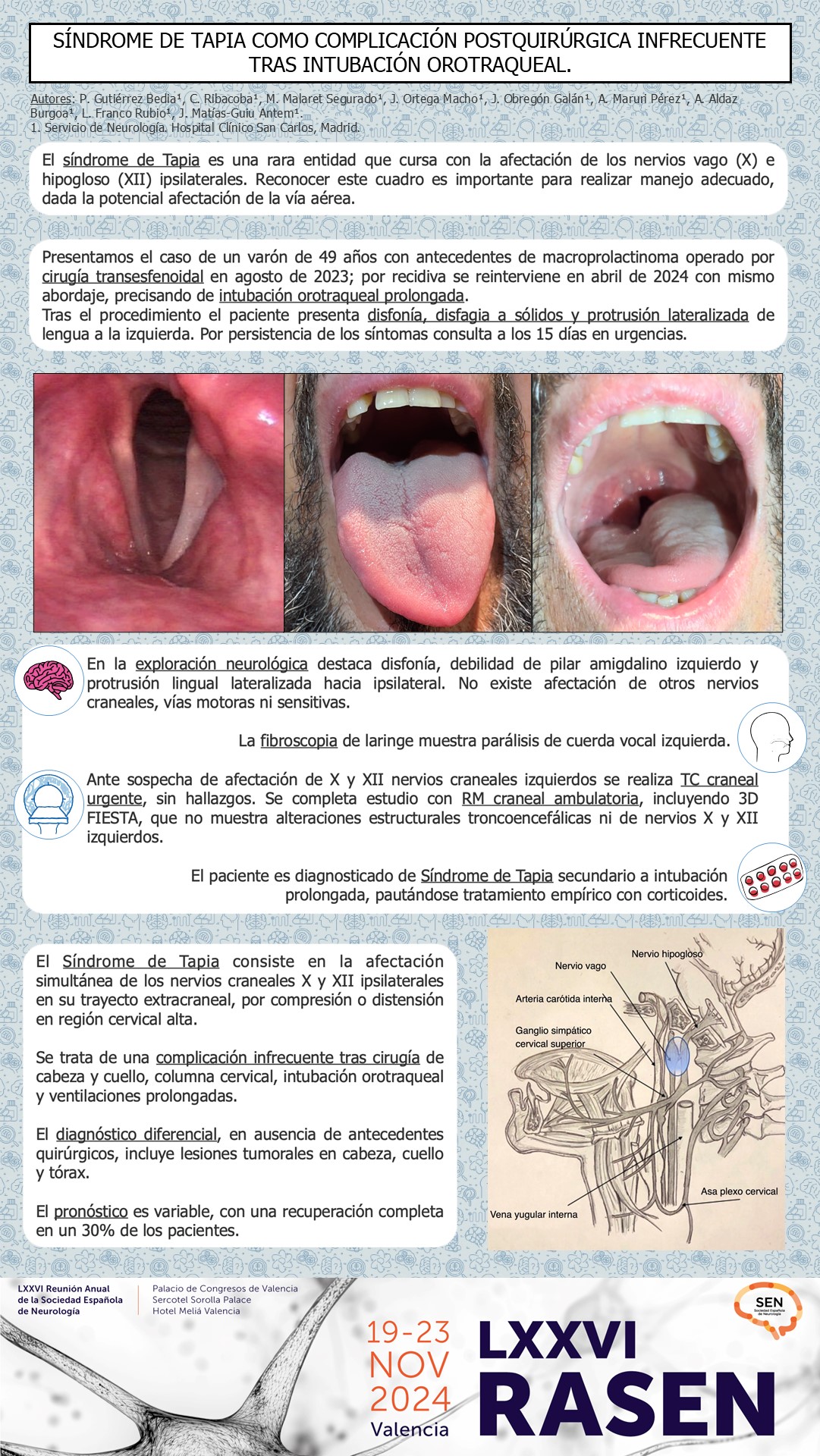 Síndrome de Tapia como complicación postquirúrgica infrecuente tras intubación orotraqueal