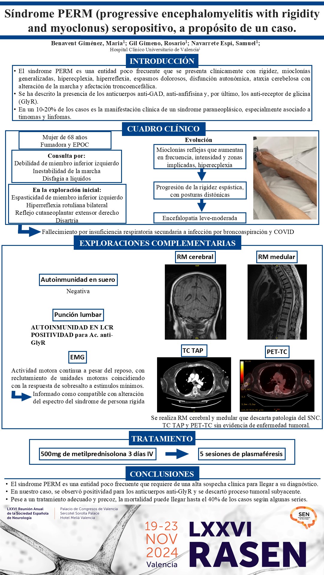 Síndrome de PERM (progressive encephalomyelitis with rigidity and myoclonus) seropositivo, a propósito de un caso