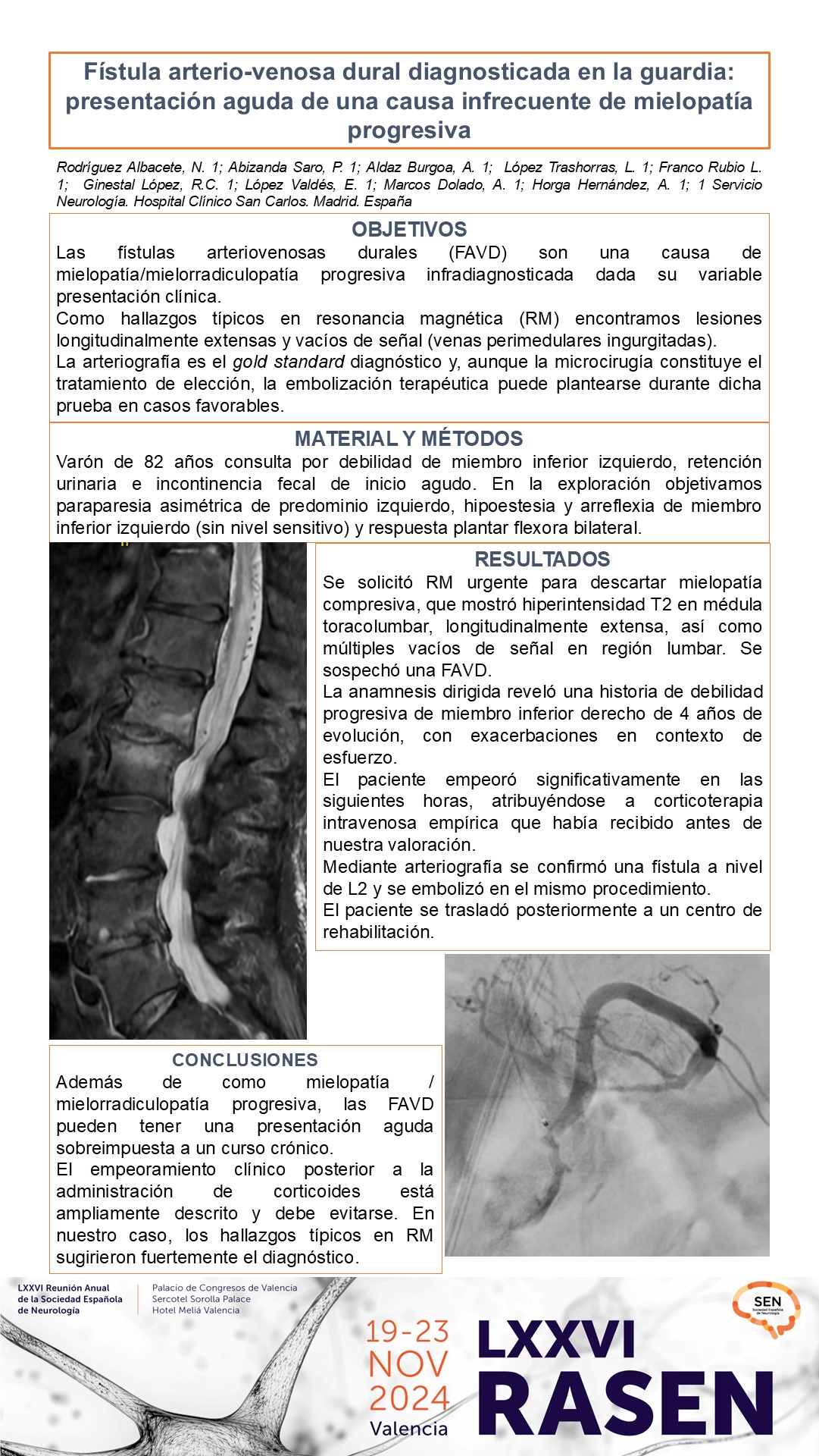 Fístula arterio-venosa dural diagnosticada en la guardia: presentación aguda de una causa infrecuente de mielopatía progresiva